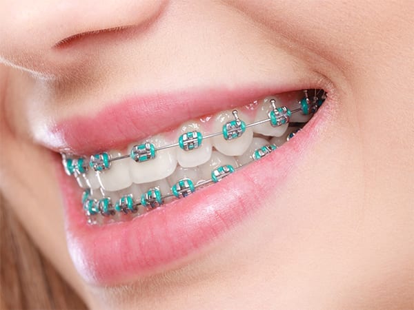 Orthodontic Problems